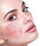 لیزر ضایعات عروقی چگونه عمل میکند؟